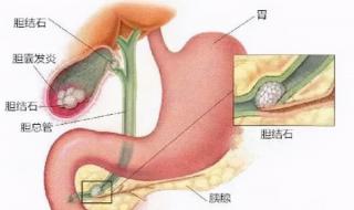 胆囊炎是怎么引起的