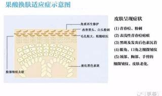 果酸换肤后注意事项